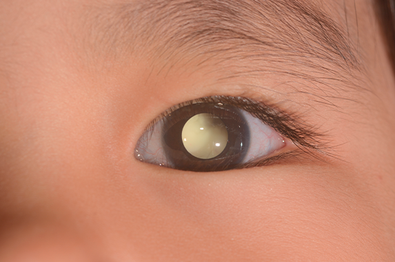 Retinoblastoma: Sinais de Alerta e Diagnóstico Precoce