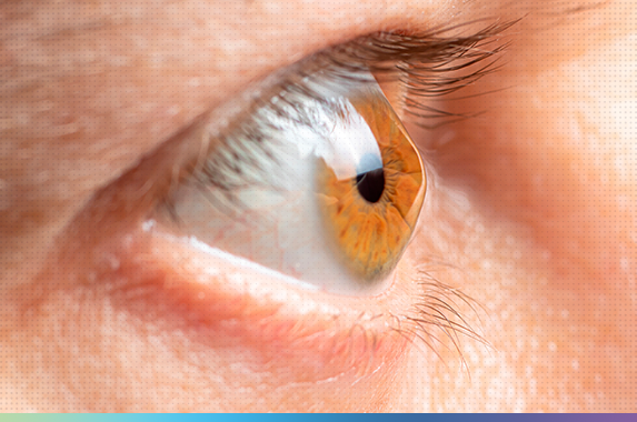 Ceratocone: Entenda Essa Doença Ocular e Seus Tratamentos