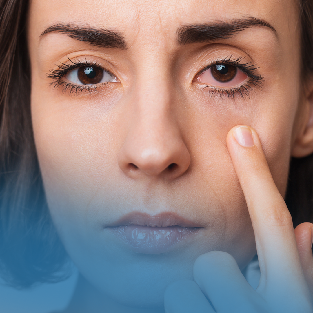 COVID-19 e Doenças Oculares: Como o Coronavírus Afeta os Olhos